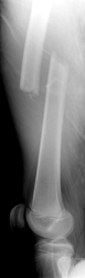 Figure 1_1314018-Femoral_Shaft.Lat